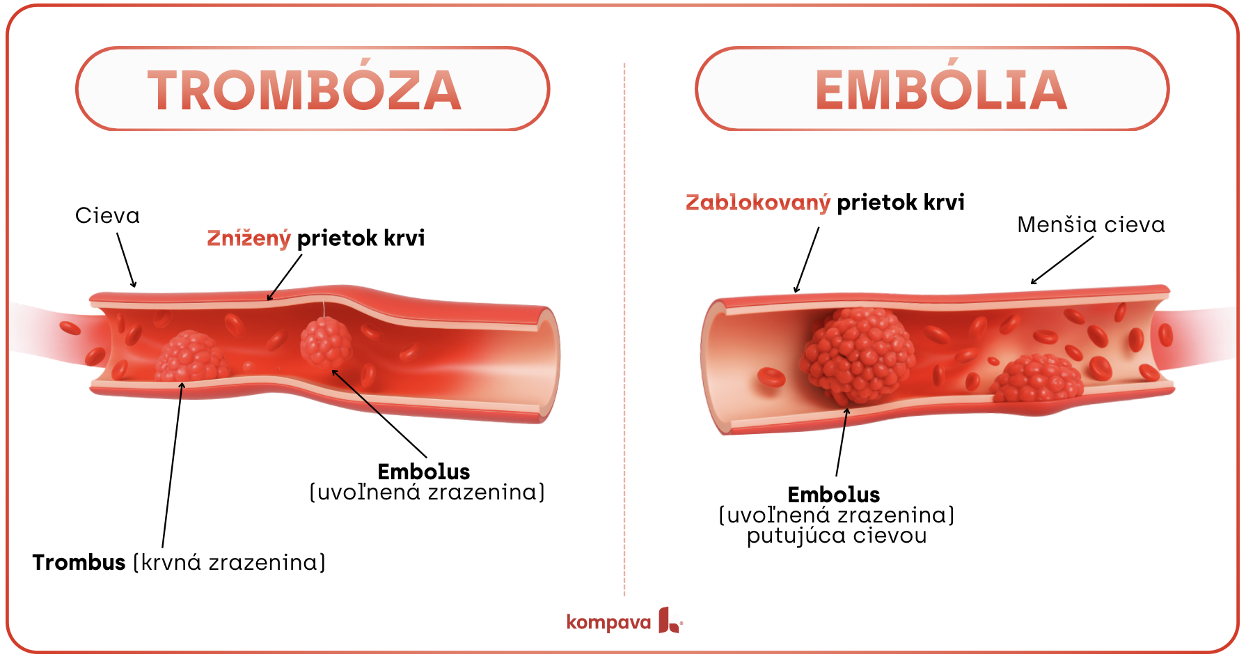 rozdiel medzi trombózou a embóliou, krvná zrazenina