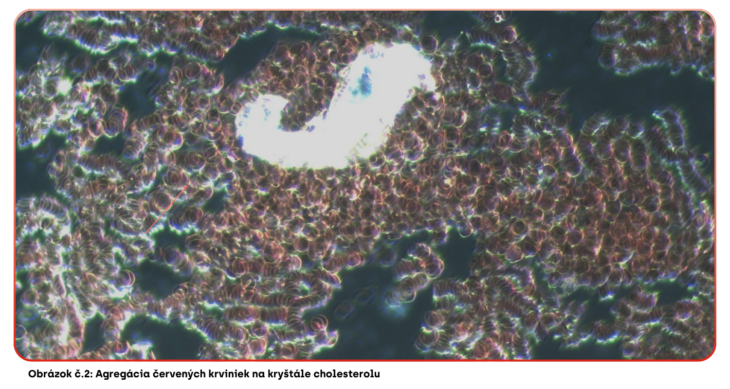 Červené krvinky a kryštál cholesterolu 